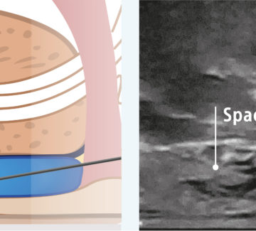 Inserimento gel SpaceOAR fra prostata e retto